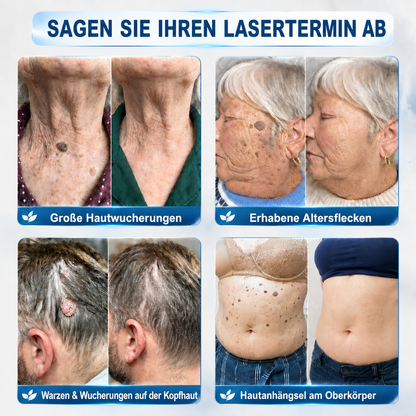 HISKIN®👩‍⚕️ 7-Tage-Hautmakel- & Hautanhängsel-Entferner Schmerzfreier Rollerball-Stift zur schonenden Entfernung von Hautanhängseln und Hautflecken – narbenfrei